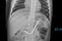 Nahas, Balita Ini Harus Dioperasi Usai Telan Puluhan Manik-manik