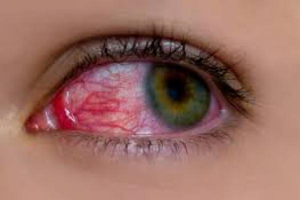 Ternyata Kebiasaan Ini Dapat Merusak Kesehatan Mata