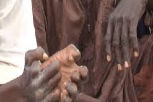 Terlantar dan Terasingkan, Penderita Lepra di Kamerun Terus Meningkat