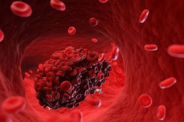 Jangan Sembarang Obati Pembekuan Darah Akibat Covid-19