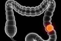 Ilmuwan Turki Temukan Titik Terang Pengobatan Kanker Berbasis Boron