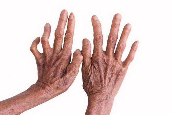 30 Januari Hari Kusta Sedunia, Hormati Pengalaman Hidup Penderita