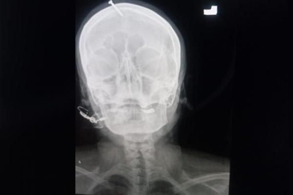 Inginkan Anak Lelaki, Tabib Pasang Paku di Kepala Wanita Pakistan