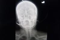 Inginkan Anak Lelaki, Tabib Pasang Paku di Kepala Wanita Pakistan