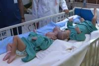 Pisahkan Bayi Kembar Siam Yaman, Ahli Bedah Saudi Operasi 15 Jam Non Stop