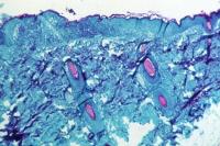 Wabah Cacar Monyet di Eropa Lebih 100 Kasus, Terbesar di Luar Afrika