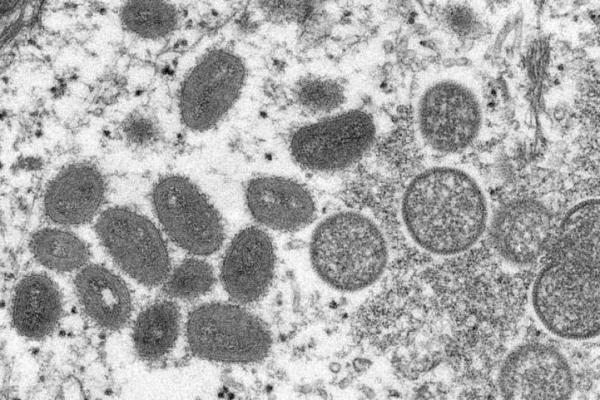 Kemungkinan Kasus Ketiga Cacar Monyet Ditemukan di Amerika