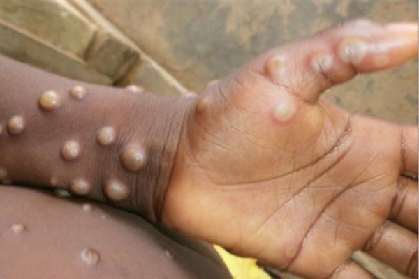 Meksiko dan Irlandia Konfirmasi Kasus Pertama Cacar Monyet