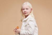 13 Juni Hari Kesadaran Albinisme Internasional, Cegah Diskriminasi pada Penyandang Albinisme