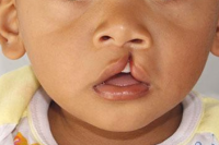 Ibu Terpapar Zat Kimia Sebabkan Anak Bibir Sumbing