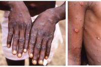 Dinkes Makasar Rilis Suspek Cacar Monyet Kedua 