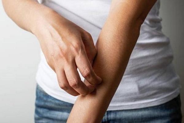 Ilustrasi reaksi alergi (FOTO: SHUTTERSTOCK) 