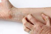 Tips Sederhana Atasi Kulit Kering agar Tetap Sehat