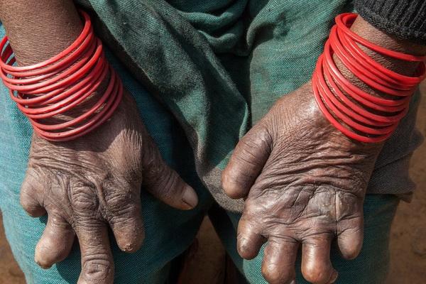 29 Januari Hari Kusta Sedunia, Penderita Bisa Jalani Kehidupan yang Bermartabat