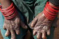 29 Januari Hari Kusta Sedunia, Penderita Bisa Jalani Kehidupan yang Bermartabat