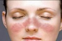 Mengenal Lupus, Penyakit Seribu Wajah yang Belum Ada Obatnya