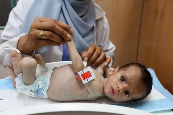 Seorang perawat memeriksa seorang anak yang kekurangan gizi, menurut petugas medis, di Rumah Sakit Nasser di Khan Younis, Jalur Gaza selatan, 25 Juli 2025. REUTERS 