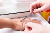 Ilustrasi - penyakit kusta (Foto: alomedika)