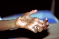 Ilustrasi - lima tanda awal penyakit kusta yang sering diabaikan (Foto: alomedika)