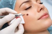 Ilustrasi foto operasi tahi lalat