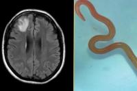 Kasus medis langka, cacing ular yang belum pernah menginfeksi manusia ditemukan hidup di otak seorang wanita di Australia (Foto: Live Science)