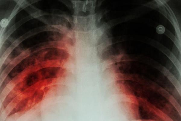 Ilustrasi - infeksi paru-paru (Foto: Berita Kesehatan) 