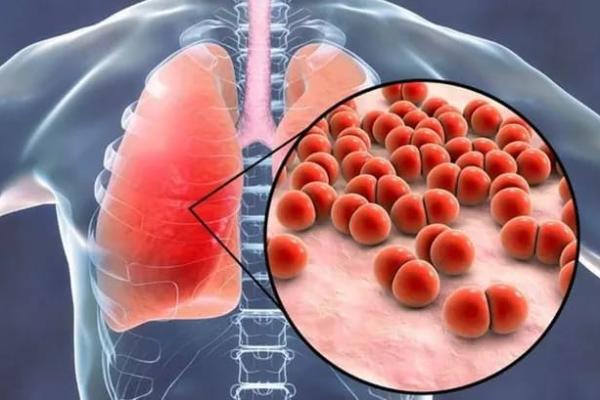 Ilustrasi - infeksi paru-paru (Foto: klik dokter) 