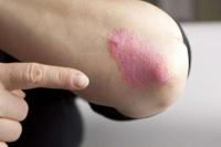 Ilustrasi - Hari Psoriasis Sedunia setiap 29 Oktober (Foto: Shutterstock)