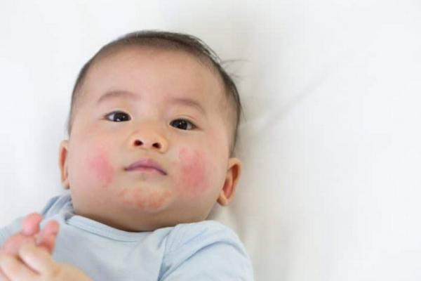 Ketahui Penyebab, Gejala, dan Cara Mencegah Penularan Hepatitis pada Bayi. (FOTO: SHUTTERSTOCK) 