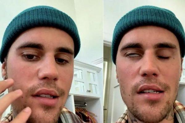 Kondisi Terkini Justin Bieber Usai Didiagnosa Sindrom Ramsay Hunt