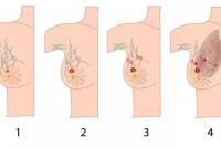 Ilustrasi. Ciri-ciri kanker payudara sesuai stadium (sumber: klikdokter.com)