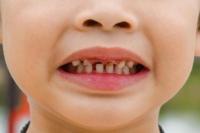 Ilustrasi penderita Aids pada anak dengan karies gigi (foto: Hellosehat)